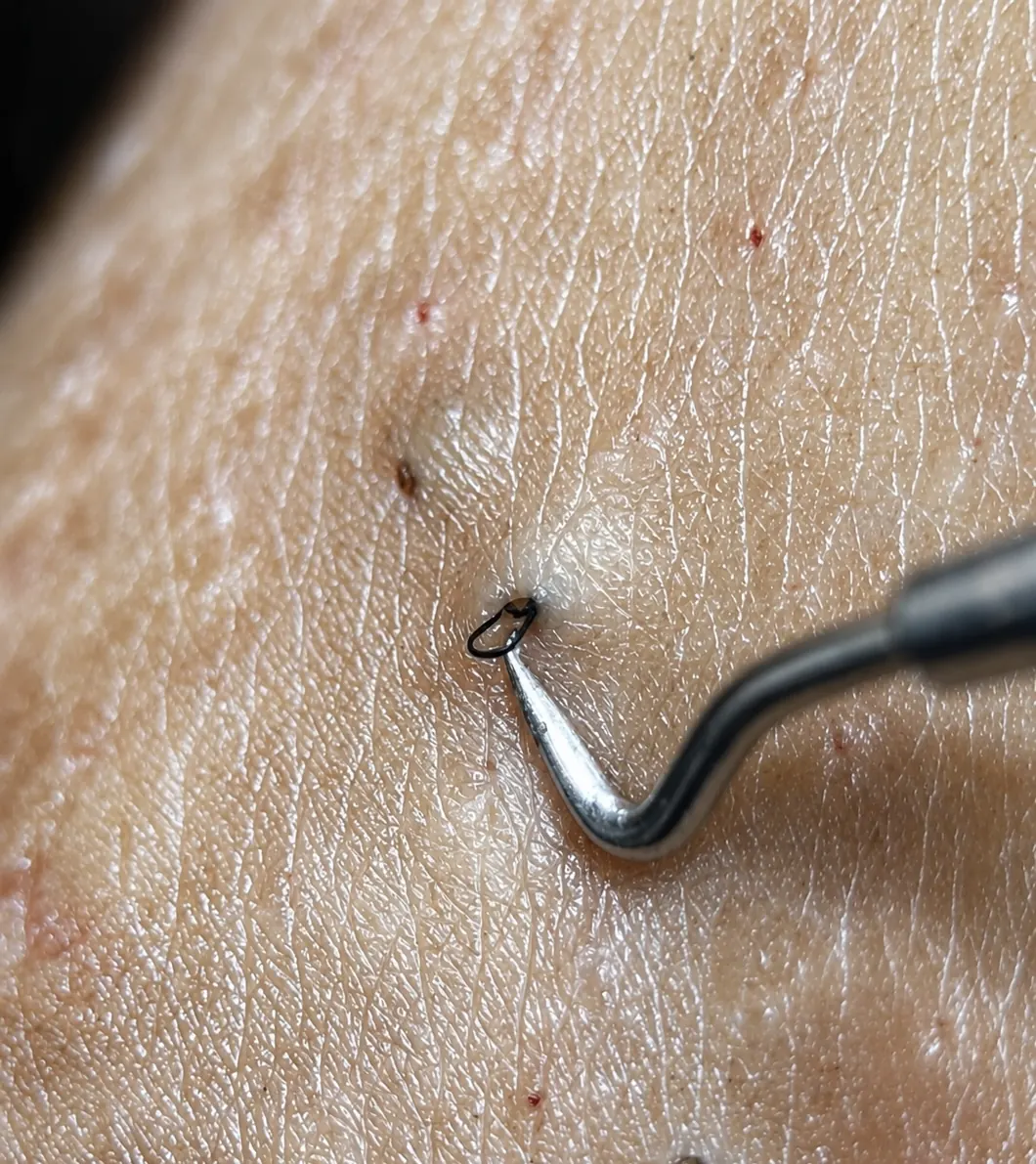 An extraction hook lifting an ingrown hair from the skin